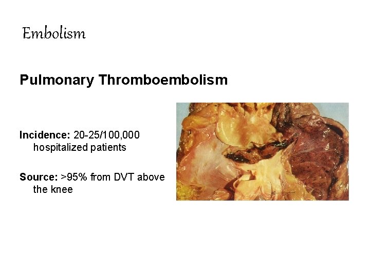 Embolism Pulmonary Thromboembolism Incidence: 20 -25/100, 000 hospitalized patients Source: >95% from DVT above