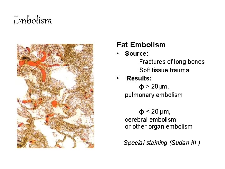 Embolism Fat Embolism • Source: Fractures of long bones Soft tissue trauma • Results: