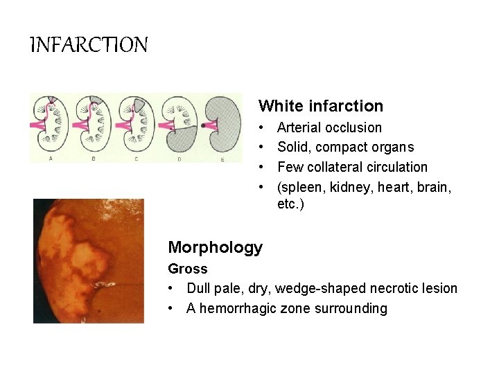 INFARCTION White infarction • • Arterial occlusion Solid, compact organs Few collateral circulation (spleen,