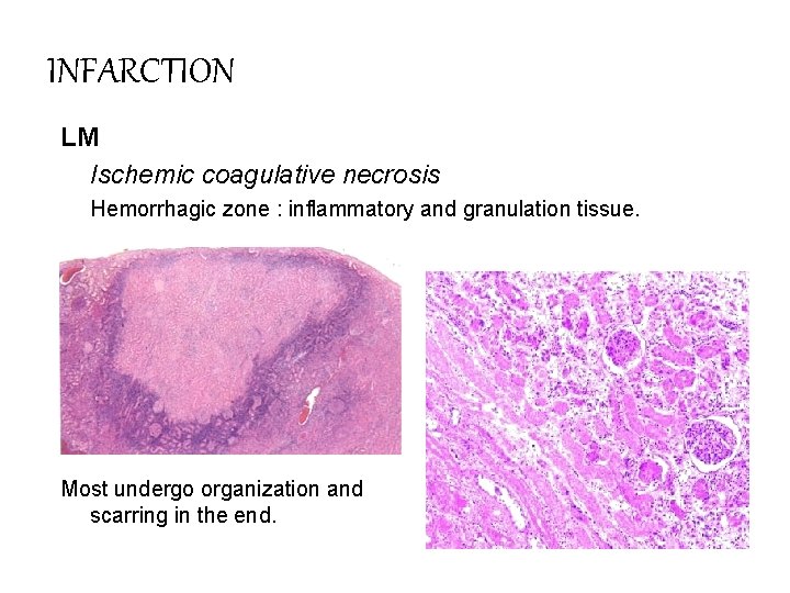 INFARCTION LM Ischemic coagulative necrosis Hemorrhagic zone : inflammatory and granulation tissue. Most undergo