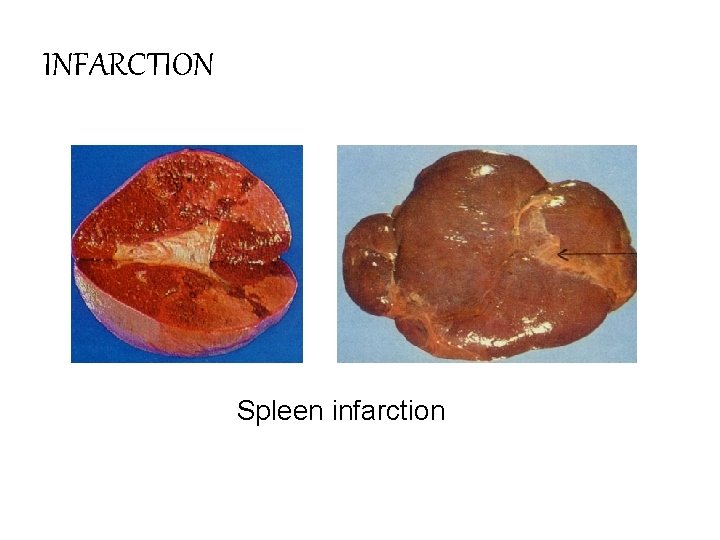 INFARCTION Spleen infarction 