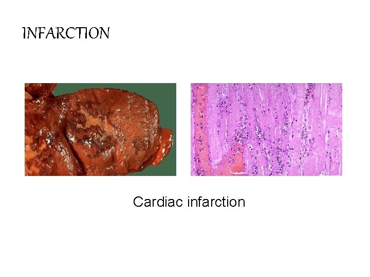 INFARCTION Cardiac infarction 