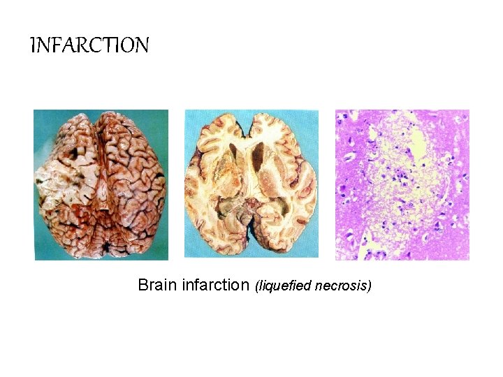 INFARCTION Brain infarction (liquefied necrosis) 