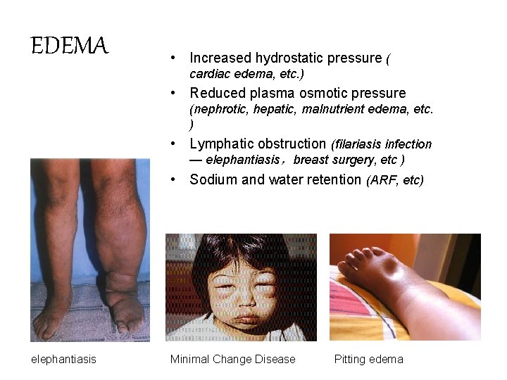 EDEMA • Increased hydrostatic pressure ( cardiac edema, etc. ) • Reduced plasma osmotic