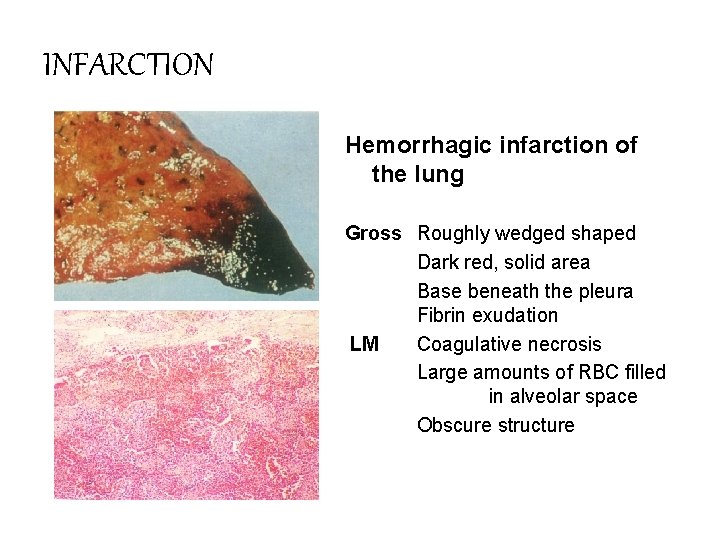 INFARCTION Hemorrhagic infarction of the lung Gross Roughly wedged shaped Dark red, solid area