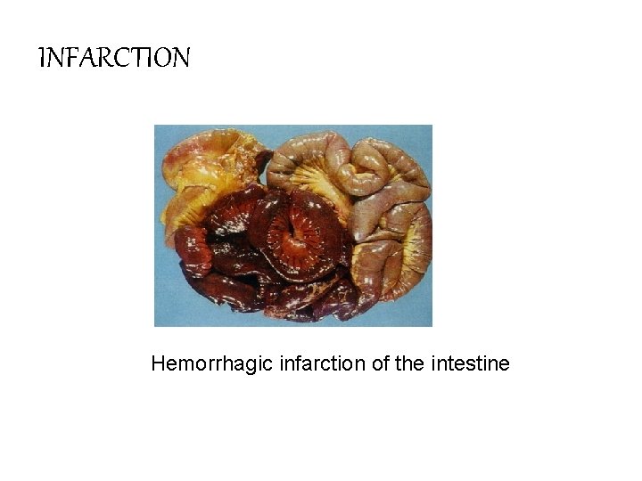 INFARCTION Hemorrhagic infarction of the intestine 