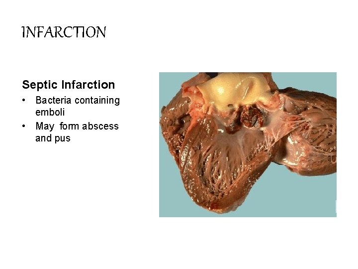 INFARCTION Septic Infarction • Bacteria containing emboli • May form abscess and pus 