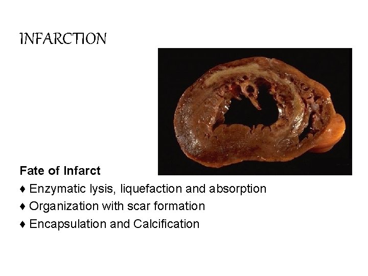 INFARCTION Fate of Infarct ♦ Enzymatic lysis, liquefaction and absorption ♦ Organization with scar