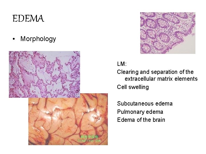 EDEMA • Morphology LM: Clearing and separation of the extracellular matrix elements Cell swelling