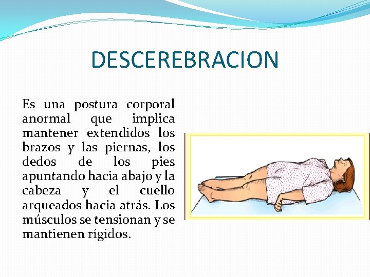 DESCEREBRACION Es una postura corporal anormal que implica mantener extendidos los brazos y las DESCEREBRACION Es una postura corporal anormal que implica mantener extendidos los brazos y las