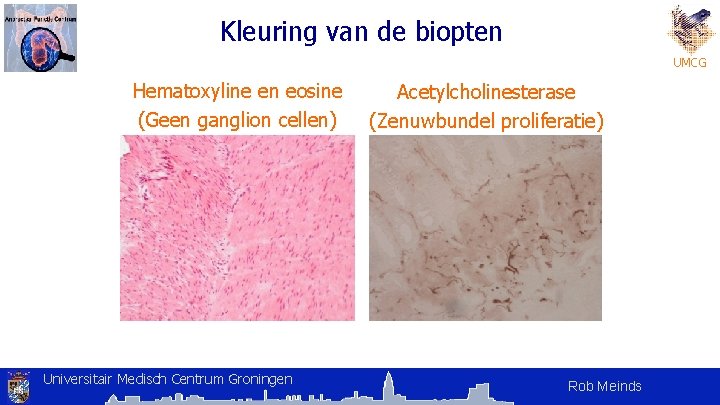 Kleuring van de biopten UMCG Hematoxyline en eosine (Geen ganglion cellen) Universitair Medisch Centrum Kleuring van de biopten UMCG Hematoxyline en eosine (Geen ganglion cellen) Universitair Medisch Centrum