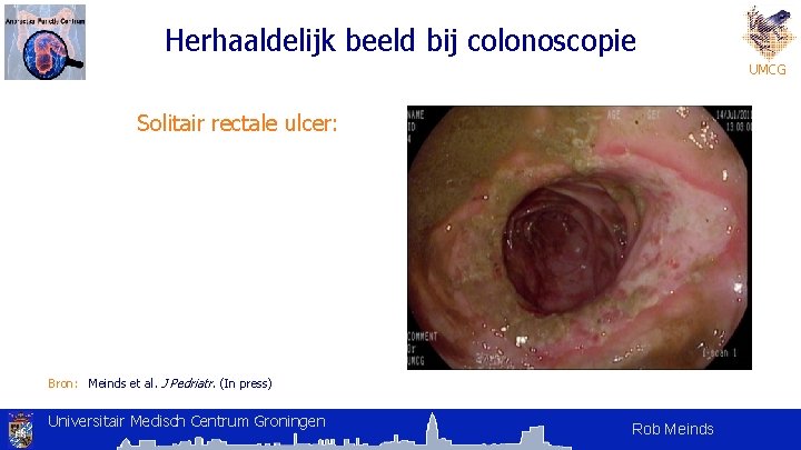 Herhaaldelijk beeld bij colonoscopie UMCG Solitair rectale ulcer: Bron: Meinds et al. J Pedriatr. Herhaaldelijk beeld bij colonoscopie UMCG Solitair rectale ulcer: Bron: Meinds et al. J Pedriatr.