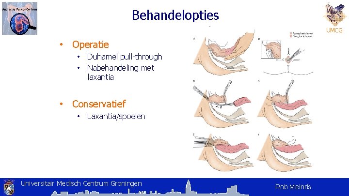 Behandelopties UMCG • Operatie • • Duhamel pull-through Nabehandeling met laxantia • Conservatief • Behandelopties UMCG • Operatie • • Duhamel pull-through Nabehandeling met laxantia • Conservatief •