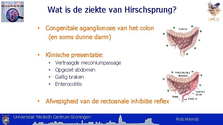 Wat is de ziekte van Hirschsprung? UMCG • Congenitale aganglionose van het colon (en Wat is de ziekte van Hirschsprung? UMCG • Congenitale aganglionose van het colon (en