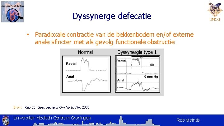 Dyssynerge defecatie UMCG • Paradoxale contractie van de bekkenbodem en/of externe anale sfincter met Dyssynerge defecatie UMCG • Paradoxale contractie van de bekkenbodem en/of externe anale sfincter met