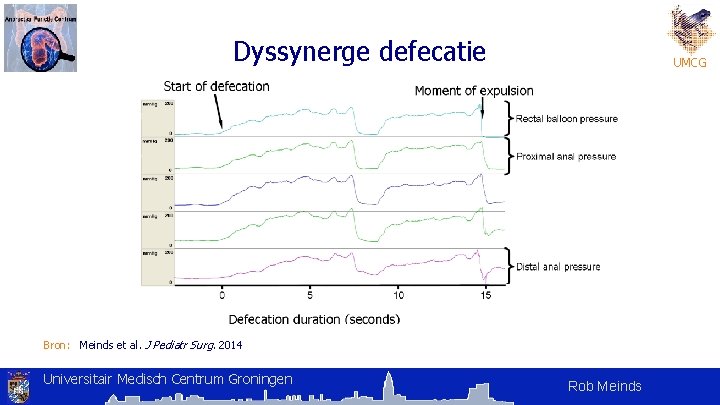 Dyssynerge defecatie UMCG Bron: Meinds et al. J Pediatr Surg. 2014 Universitair Medisch Centrum Dyssynerge defecatie UMCG Bron: Meinds et al. J Pediatr Surg. 2014 Universitair Medisch Centrum