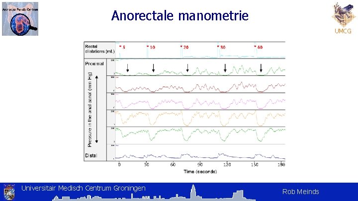 Anorectale manometrie UMCG Universitair Medisch Centrum Groningen Rob Meinds Anorectale manometrie UMCG Universitair Medisch Centrum Groningen Rob Meinds