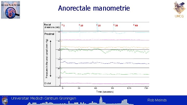 Anorectale manometrie UMCG Universitair Medisch Centrum Groningen Rob Meinds Anorectale manometrie UMCG Universitair Medisch Centrum Groningen Rob Meinds