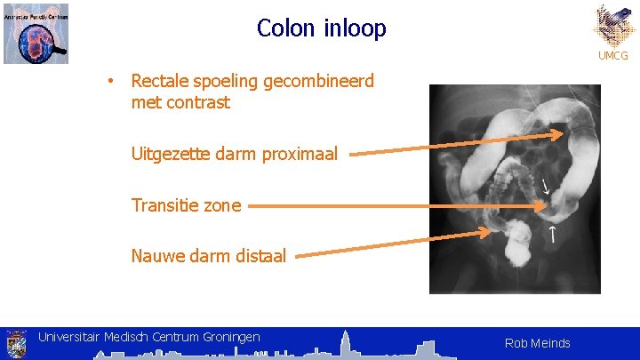 Colon inloop UMCG • Rectale spoeling gecombineerd met contrast Uitgezette darm proximaal Transitie zone Colon inloop UMCG • Rectale spoeling gecombineerd met contrast Uitgezette darm proximaal Transitie zone