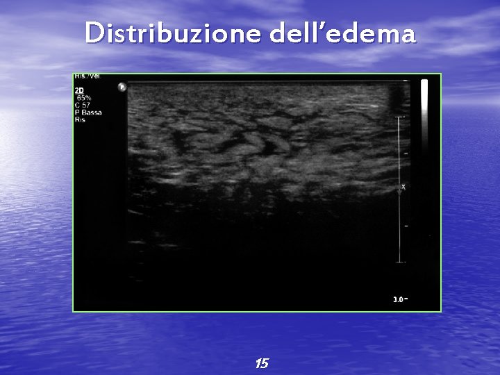 Distribuzione dell’edema 15 