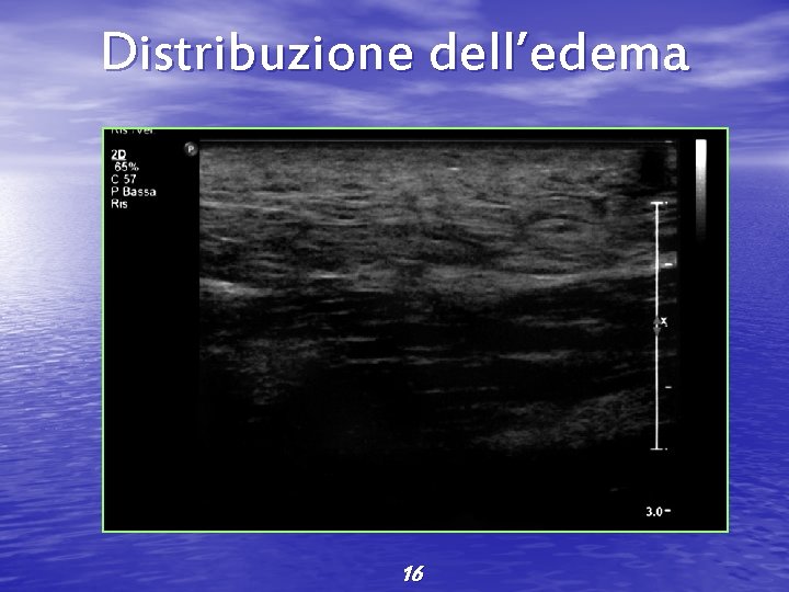 Distribuzione dell’edema 16 