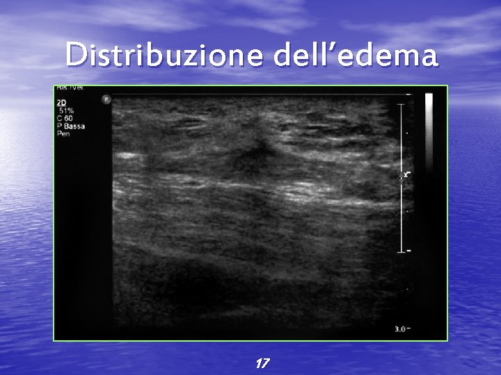 Distribuzione dell’edema 17 