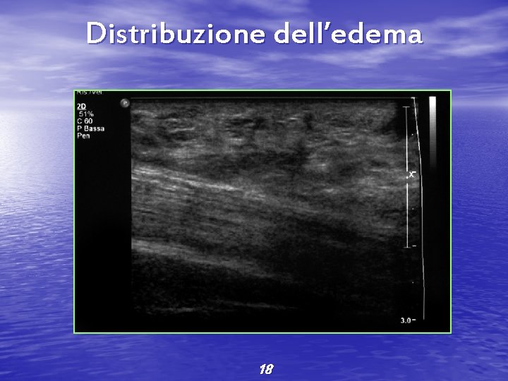 Distribuzione dell’edema 18 