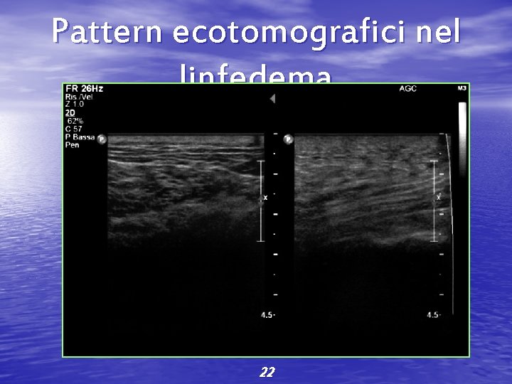 Pattern ecotomografici nel linfedema 22 