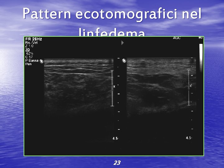 Pattern ecotomografici nel linfedema 23 