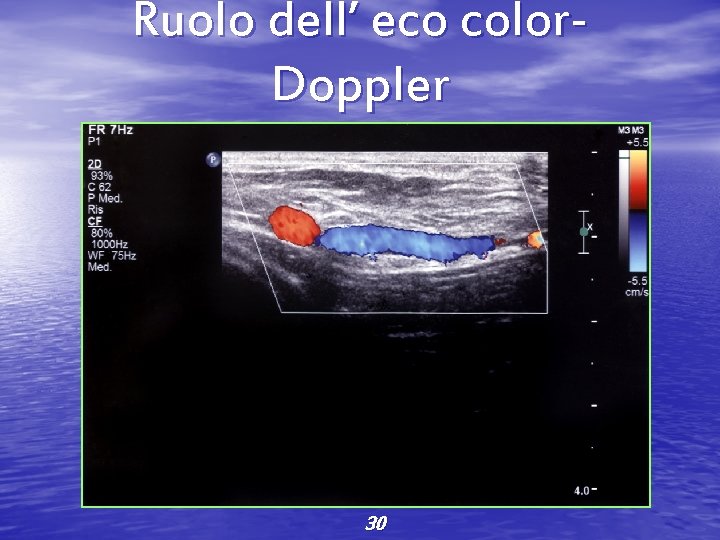 Ruolo dell’ eco color. Doppler 30 