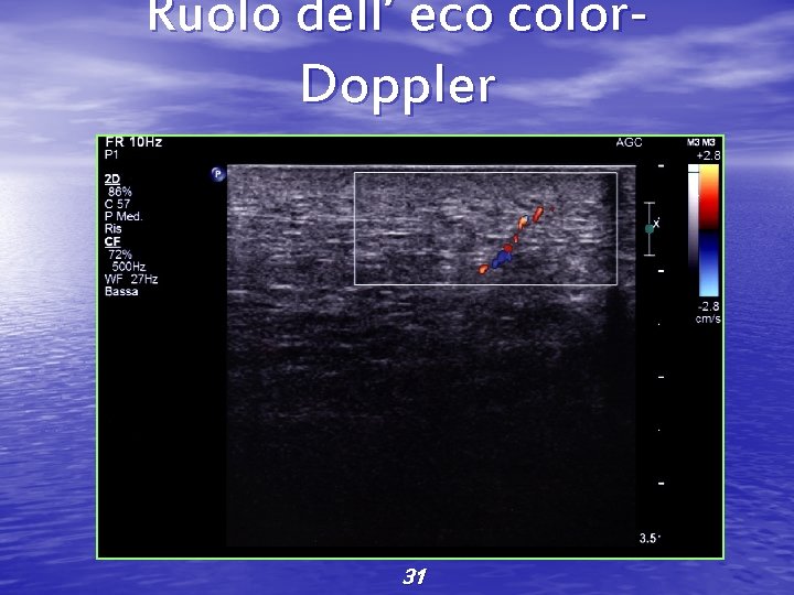 Ruolo dell’ eco color. Doppler 31 