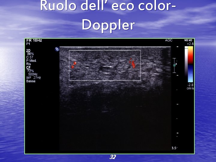 Ruolo dell’ eco color. Doppler 32 