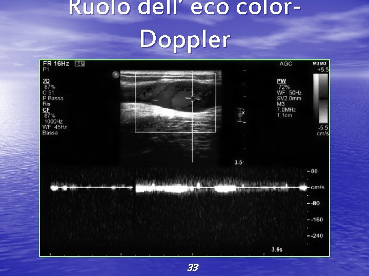 Ruolo dell’ eco color. Doppler 33 