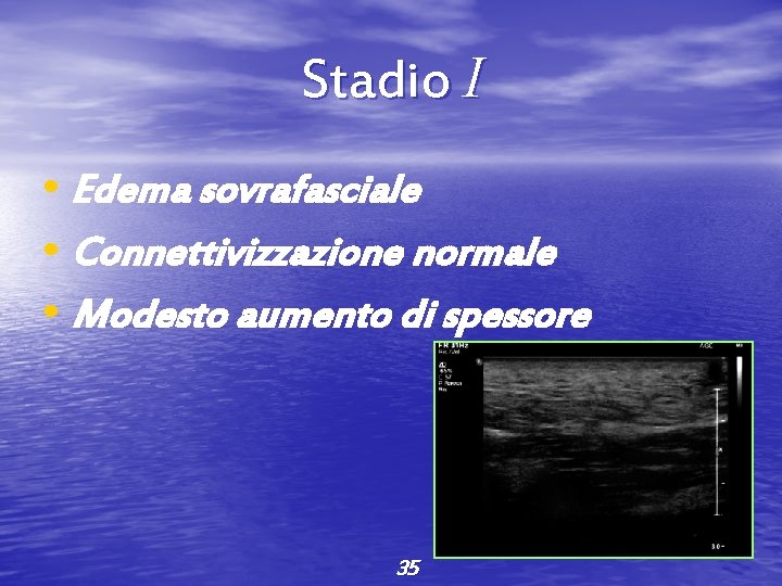 Stadio I • Edema sovrafasciale • Connettivizzazione normale • Modesto aumento di spessore 35