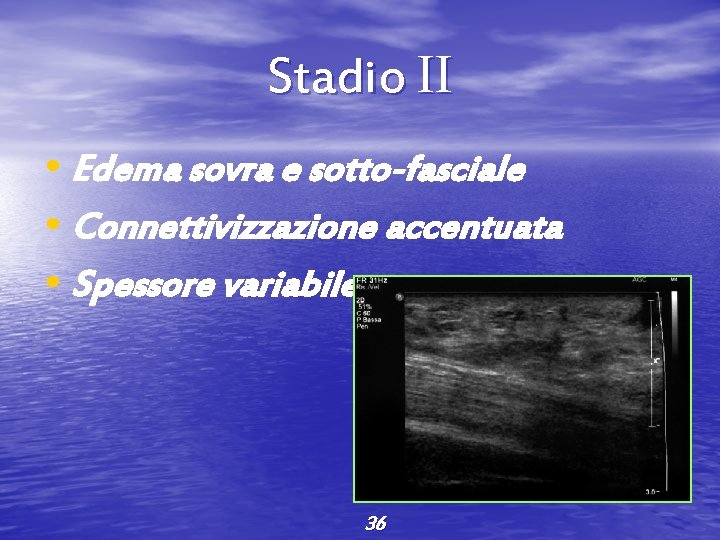 Stadio II • Edema sovra e sotto-fasciale • Connettivizzazione accentuata • Spessore variabile 36