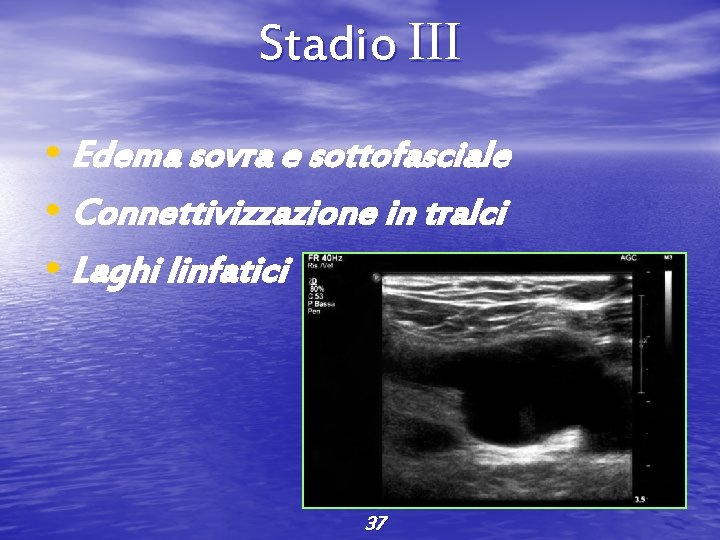 Stadio III • Edema sovra e sottofasciale • Connettivizzazione in tralci • Laghi linfatici