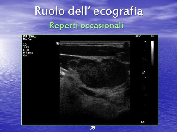Ruolo dell’ ecografia Reperti occasionali 38 