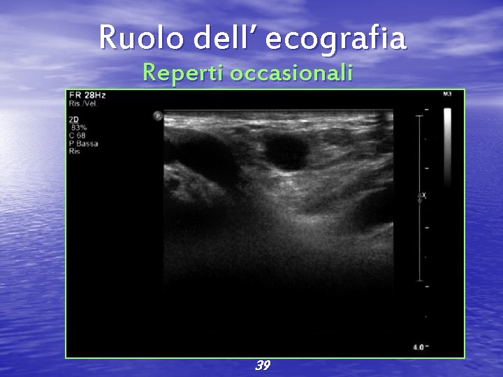 Ruolo dell’ ecografia Reperti occasionali 39 