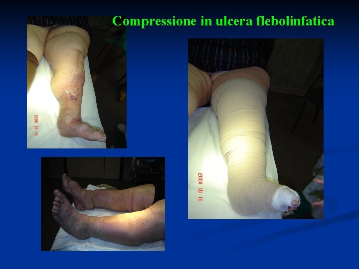 Compressione in ulcera flebolinfatica 