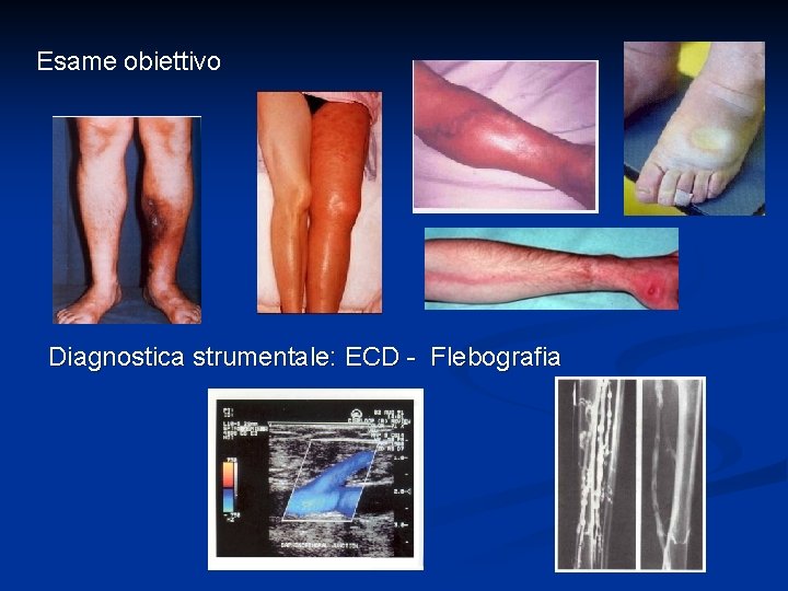 Esame obiettivo Diagnostica strumentale: ECD - Flebografia 