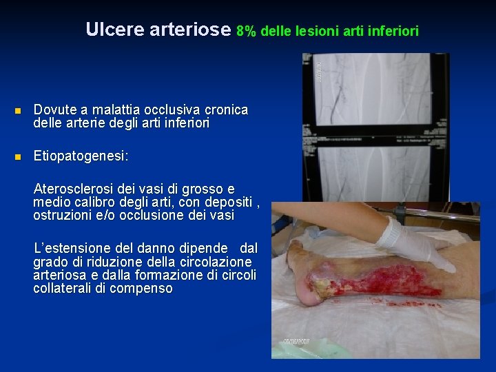 Ulcere arteriose 8% delle lesioni arti inferiori n Dovute a malattia occlusiva cronica delle