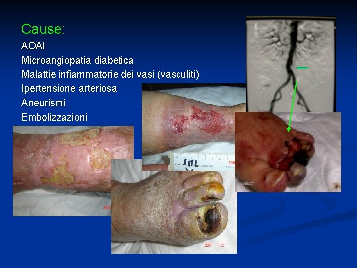 Cause: AOAI Microangiopatia diabetica Malattie infiammatorie dei vasi (vasculiti) Ipertensione arteriosa Aneurismi Embolizzazioni 