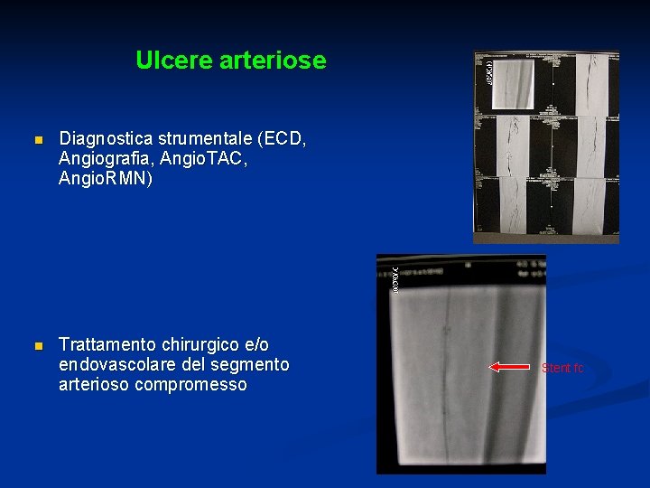 Ulcere arteriose n Diagnostica strumentale (ECD, Angiografia, Angio. TAC, Angio. RMN) n Trattamento chirurgico