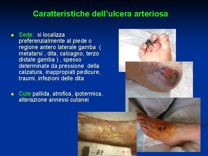 Caratteristiche dell’ulcera arteriosa n Sede: si localizza preferenzialmente al piede o regione antero laterale
