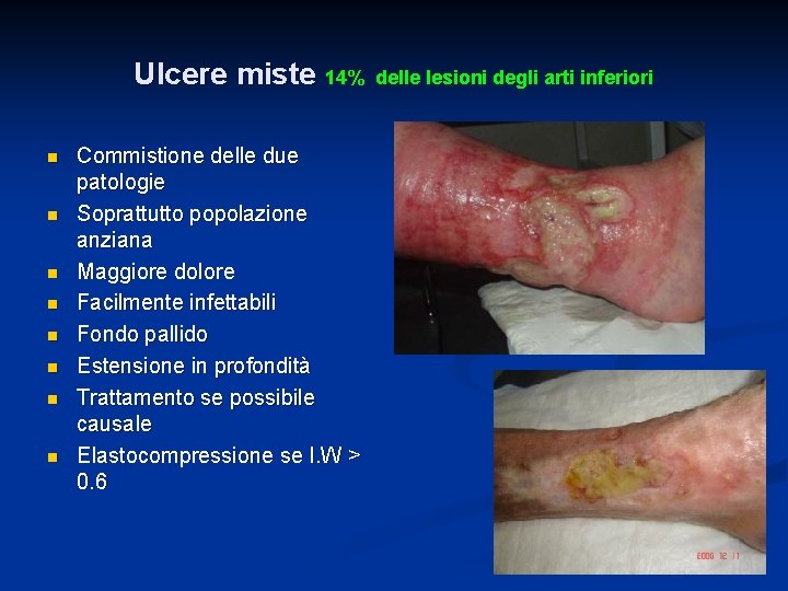 Ulcere miste 14% n n n n Commistione delle due patologie Soprattutto popolazione anziana