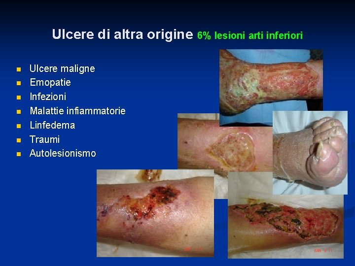 Ulcere di altra origine 6% lesioni arti inferiori n n n n Ulcere maligne