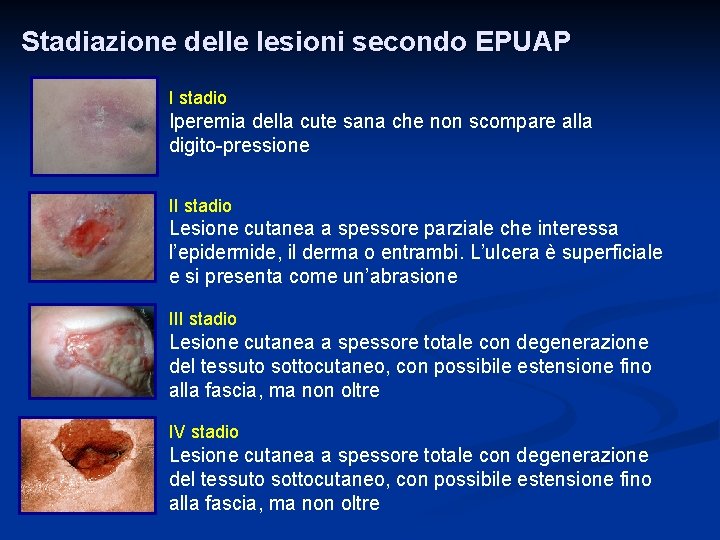 Stadiazione delle lesioni secondo EPUAP I stadio Iperemia della cute sana che non scompare