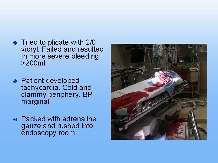 ¥ Tried to plicate with 2/0 vicryl. Failed and resulted in more severe bleeding ¥ Tried to plicate with 2/0 vicryl. Failed and resulted in more severe bleeding