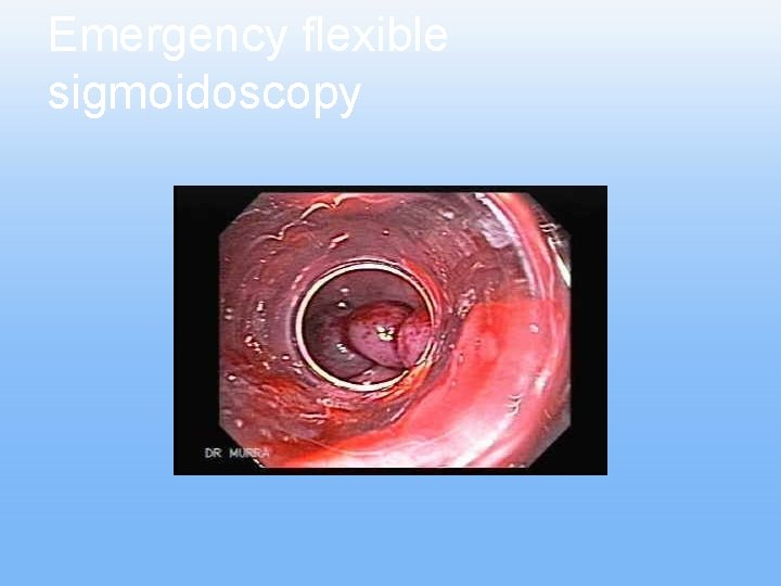 Emergency flexible sigmoidoscopy Emergency flexible sigmoidoscopy