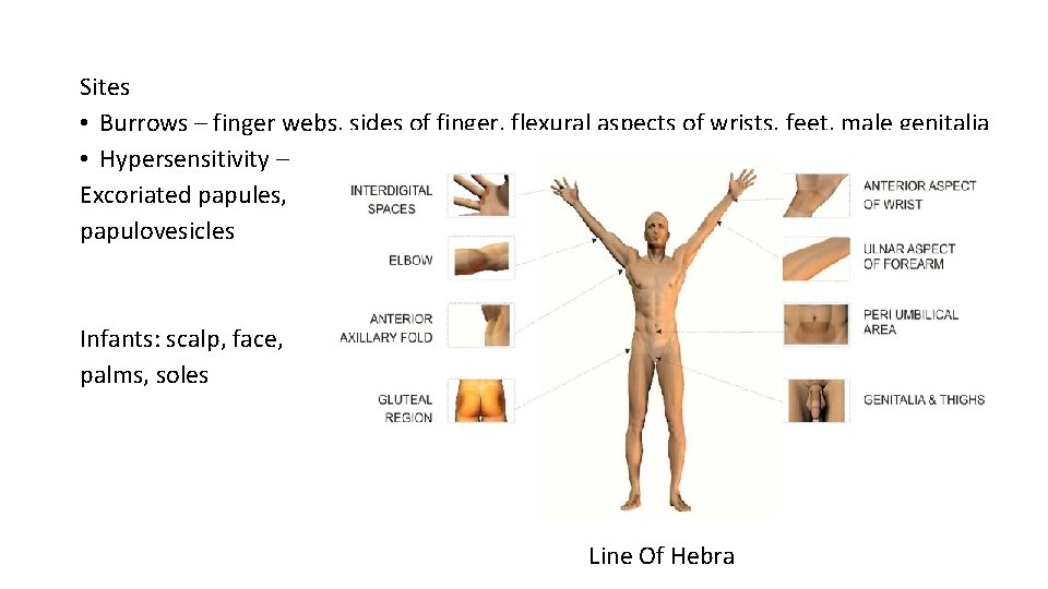 Sites • Burrows – finger webs, sides of finger, flexural aspects of wrists, feet,